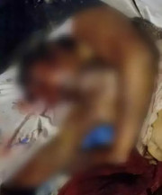 Mulher que teve o rosto desfigurado em ataque de ex perdeu olho